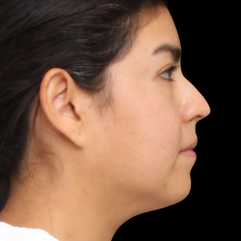 Rhinoplasty Before & After Gallery - Patient 662876 - Image 9