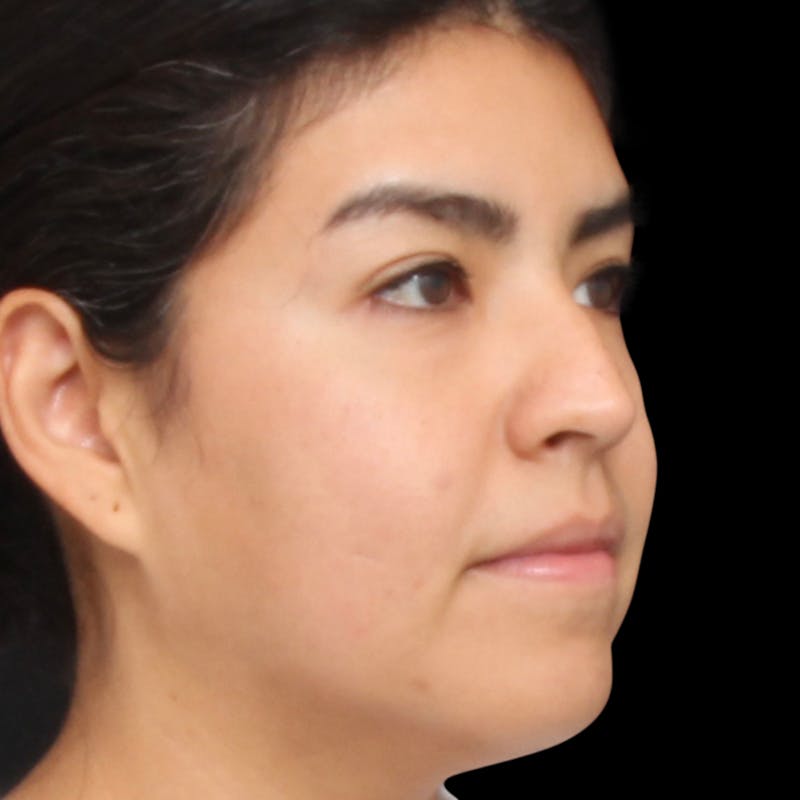 Rhinoplasty Before & After Gallery - Patient 662876 - Image 3
