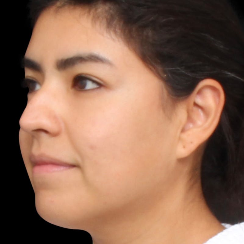 Rhinoplasty Before & After Gallery - Patient 662876 - Image 7