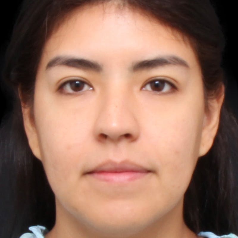 Rhinoplasty Before & After Gallery - Patient 662876 - Image 5
