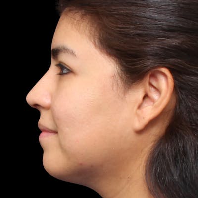 Rhinoplasty Before & After Gallery - Patient 662876 - Image 2