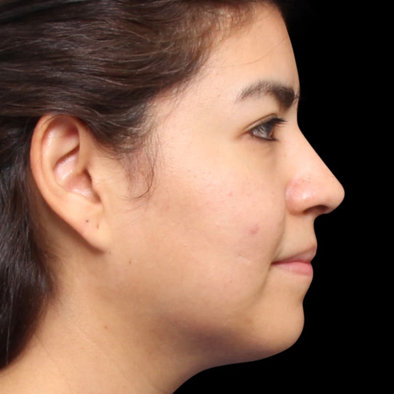 Rhinoplasty Before & After Gallery - Patient 662876 - Image 10