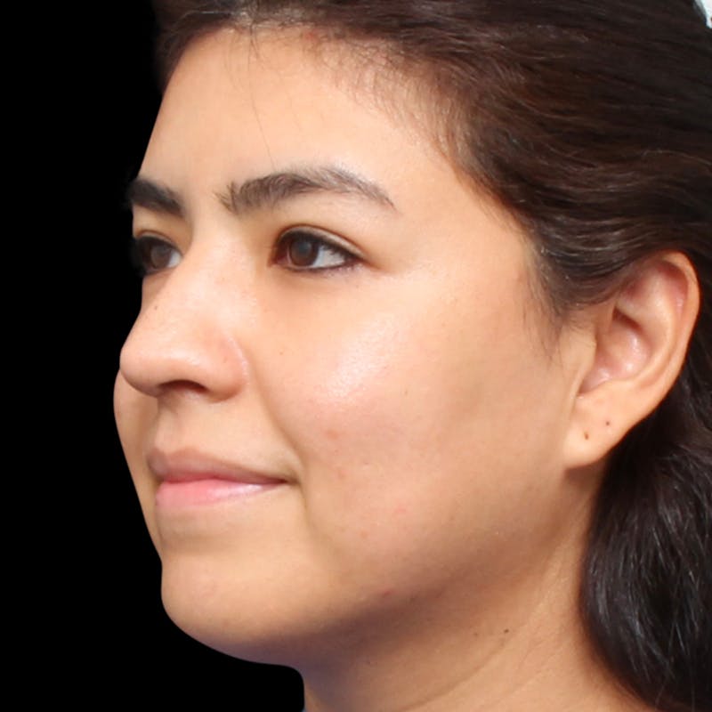 Rhinoplasty Before & After Gallery - Patient 662876 - Image 8