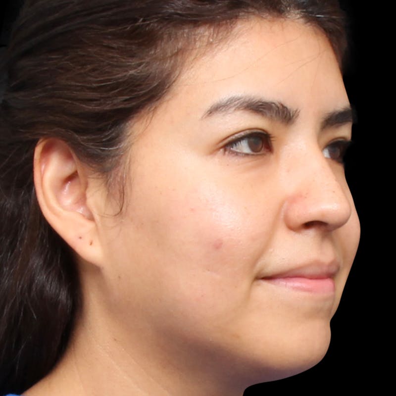 Rhinoplasty Before & After Gallery - Patient 662876 - Image 4