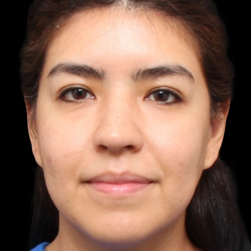 Rhinoplasty Before & After Gallery - Patient 662876 - Image 6