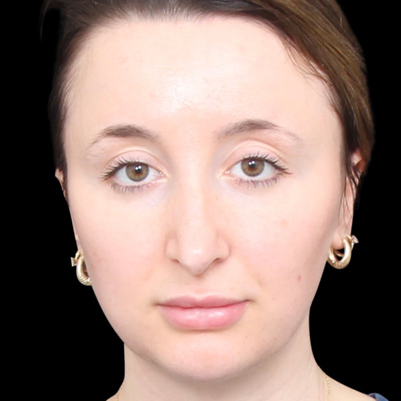 Rhinoplasty Before & After Gallery - Patient 253441 - Image 7