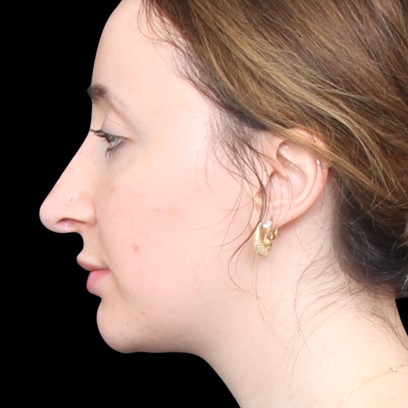 Rhinoplasty Before & After Gallery - Patient 253441 - Image 1
