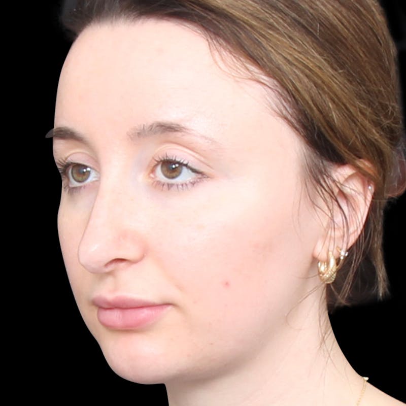 Rhinoplasty Before & After Gallery - Patient 253441 - Image 5