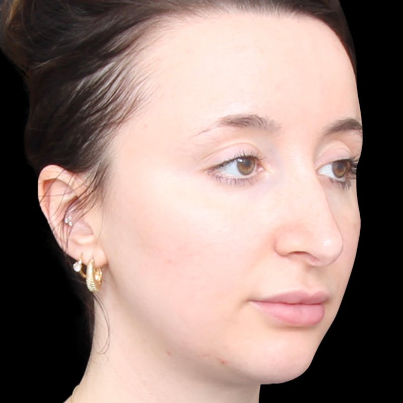 Rhinoplasty Before & After Gallery - Patient 253441 - Image 3