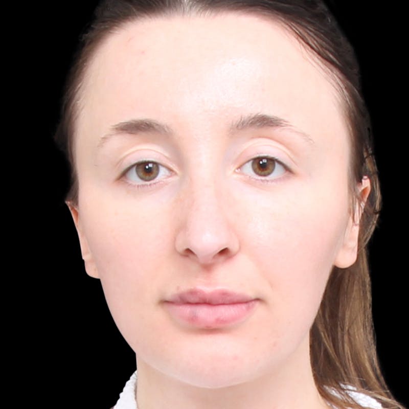 Rhinoplasty Before & After Gallery - Patient 253441 - Image 8