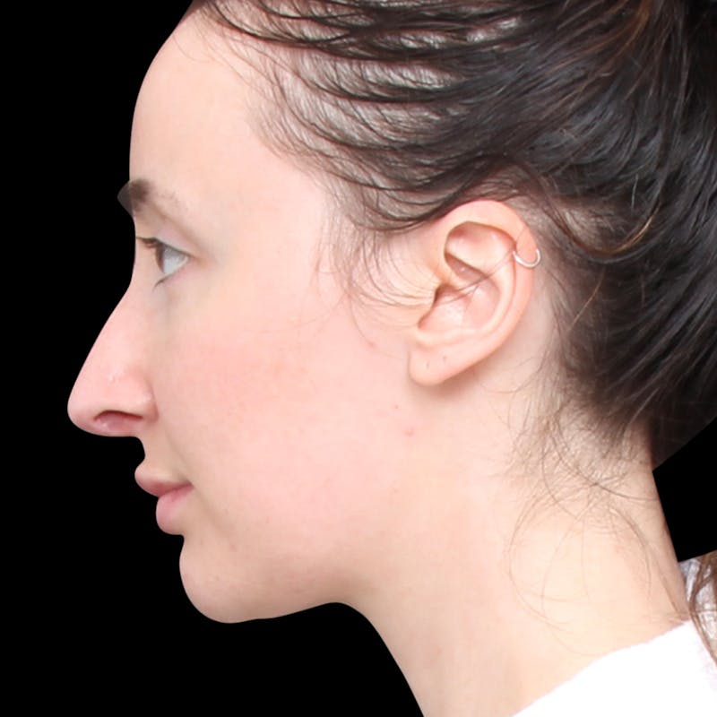 Rhinoplasty Before & After Gallery - Patient 253441 - Image 2