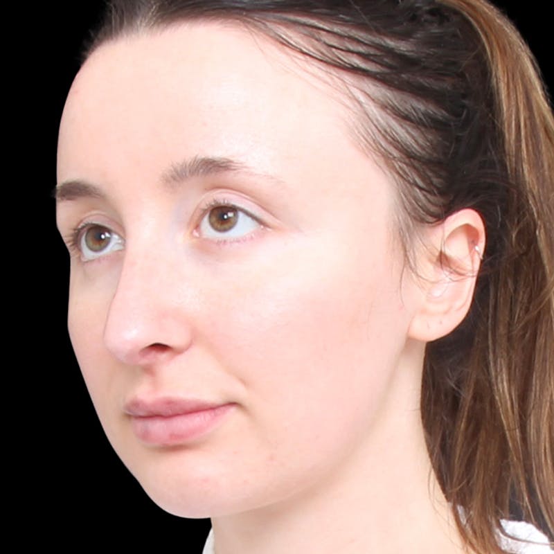 Rhinoplasty Before & After Gallery - Patient 253441 - Image 6