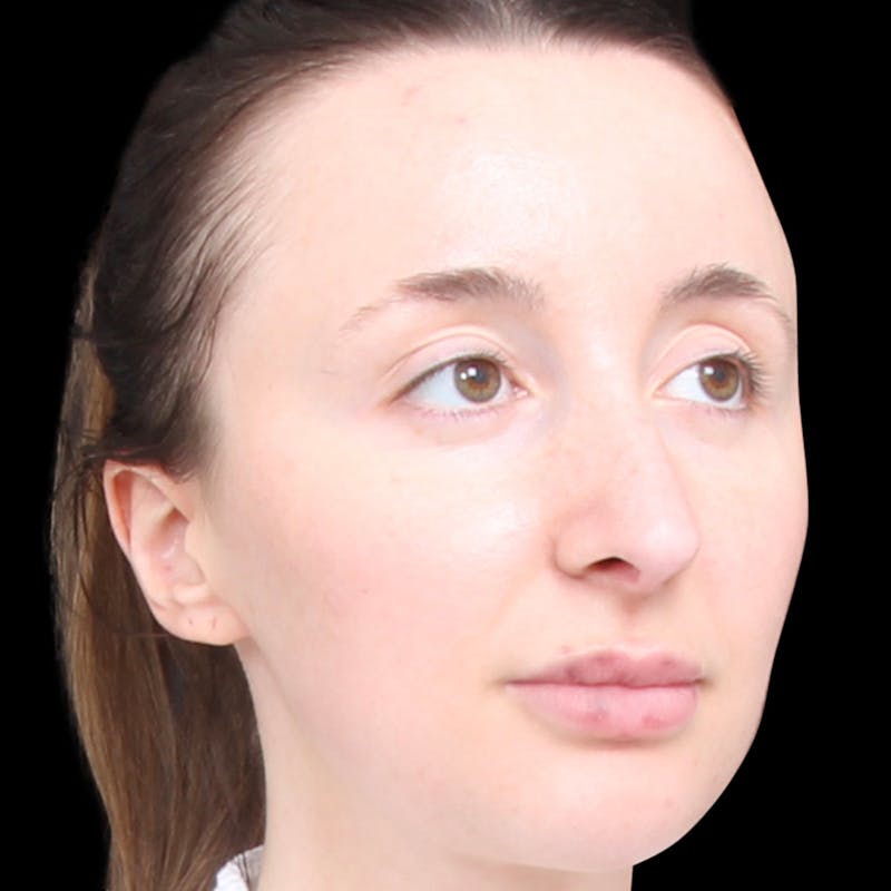 Rhinoplasty Before & After Gallery - Patient 253441 - Image 4