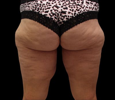 Thigh Lift Before & After Gallery - Patient 192156 - Image 1