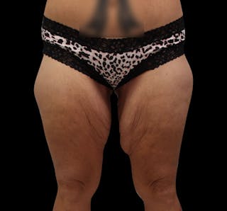 Thigh Lift Before & After Gallery - Patient 192156 - Image 4