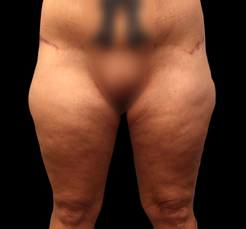 Thigh Lift Before & After Gallery - Patient 192156 - Image 3