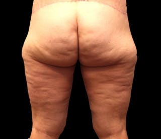 Thigh Lift Before & After Gallery - Patient 192156 - Image 2