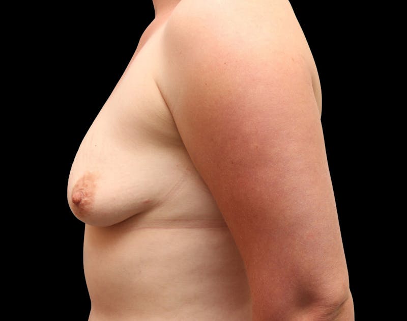 Breast Augmentation Before & After Gallery - Patient 302347 - Image 9