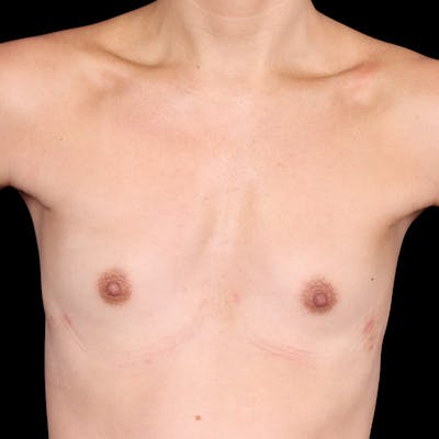 Breast Augmentation Before & After Gallery - Patient 147859 - Image 1