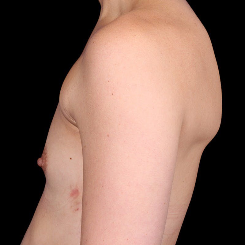Breast Augmentation Before & After Gallery - Patient 147859 - Image 9