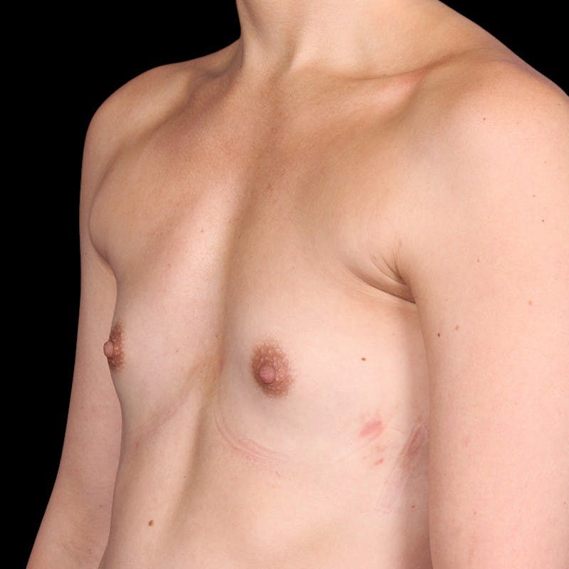 Breast Augmentation Before & After Gallery - Patient 147859 - Image 7