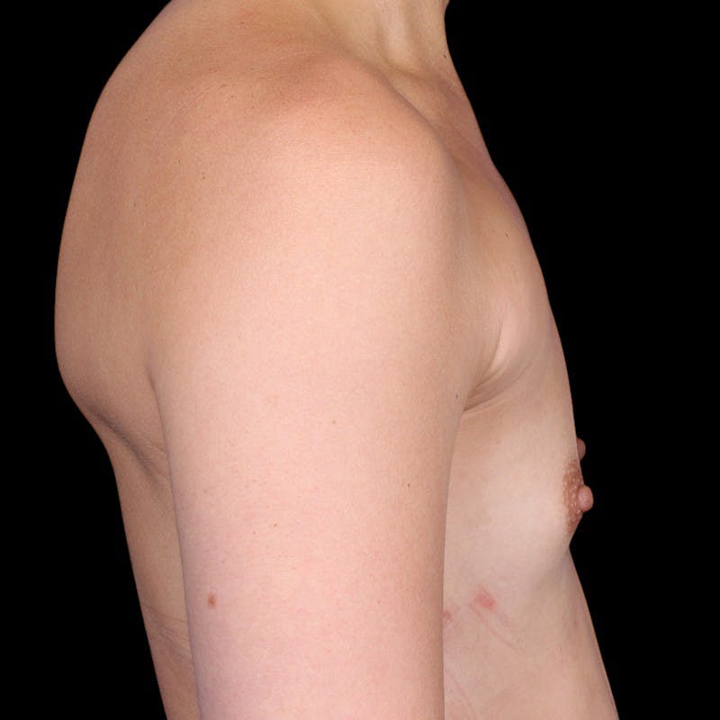 Breast Augmentation Before & After Gallery - Patient 147859 - Image 5