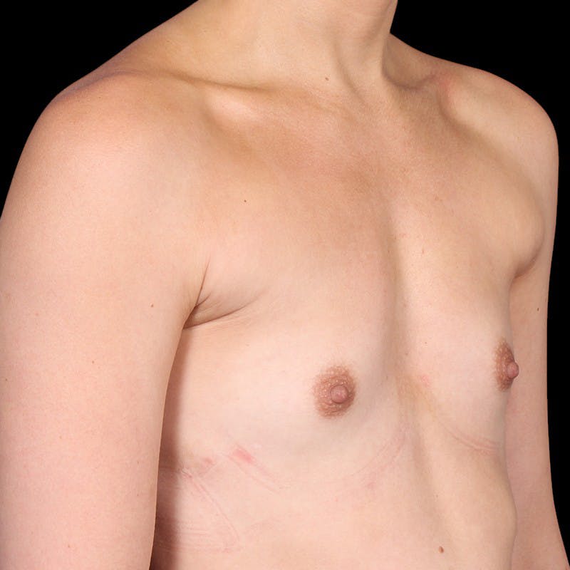 Breast Augmentation Before & After Gallery - Patient 147859 - Image 3