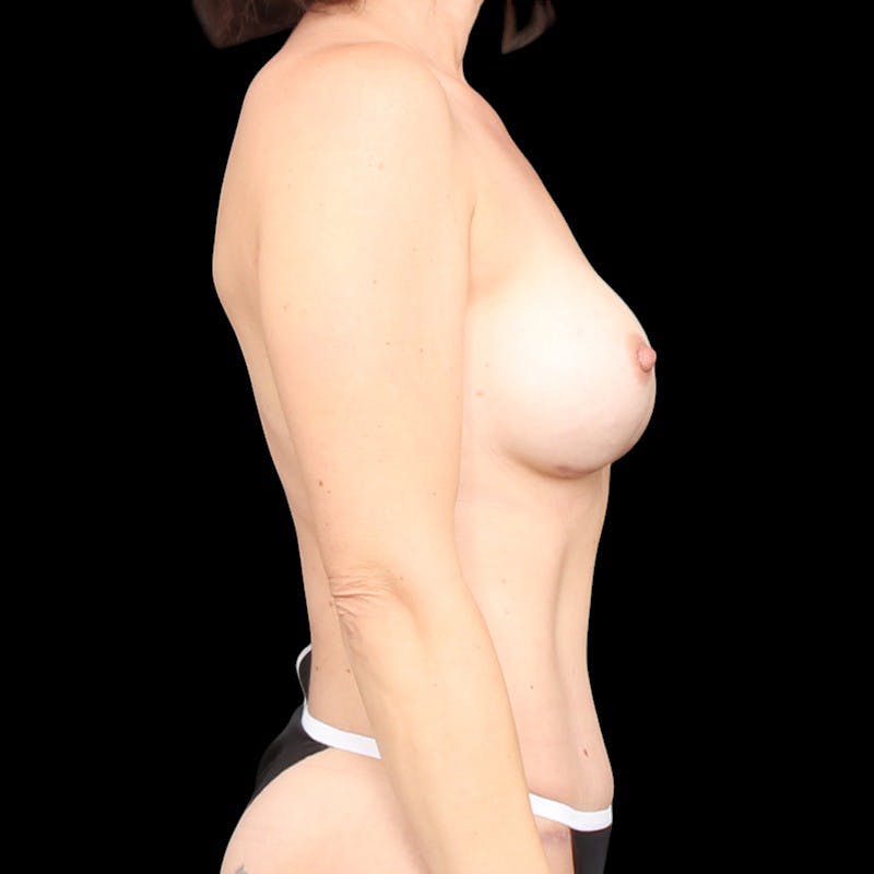 Breast Augmentation Before & After Gallery - Patient 148620 - Image 6
