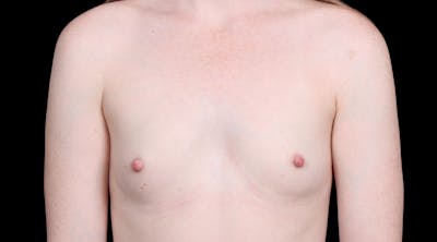 Breast Augmentation Before & After Gallery - Patient 278429 - Image 1