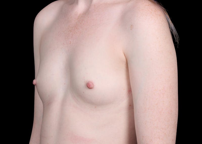 Breast Augmentation Before & After Gallery - Patient 278429 - Image 9