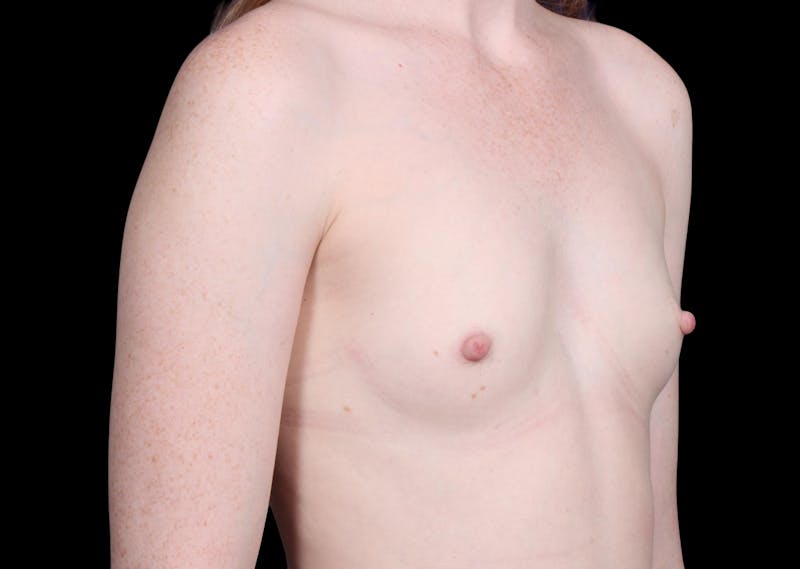 Breast Augmentation Before & After Gallery - Patient 278429 - Image 3