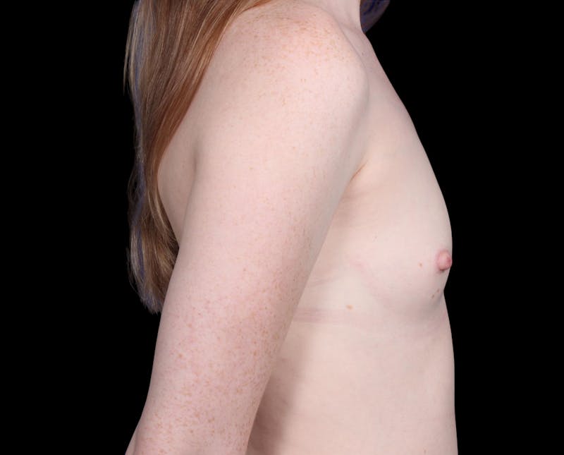 Breast Augmentation Before & After Gallery - Patient 278429 - Image 5