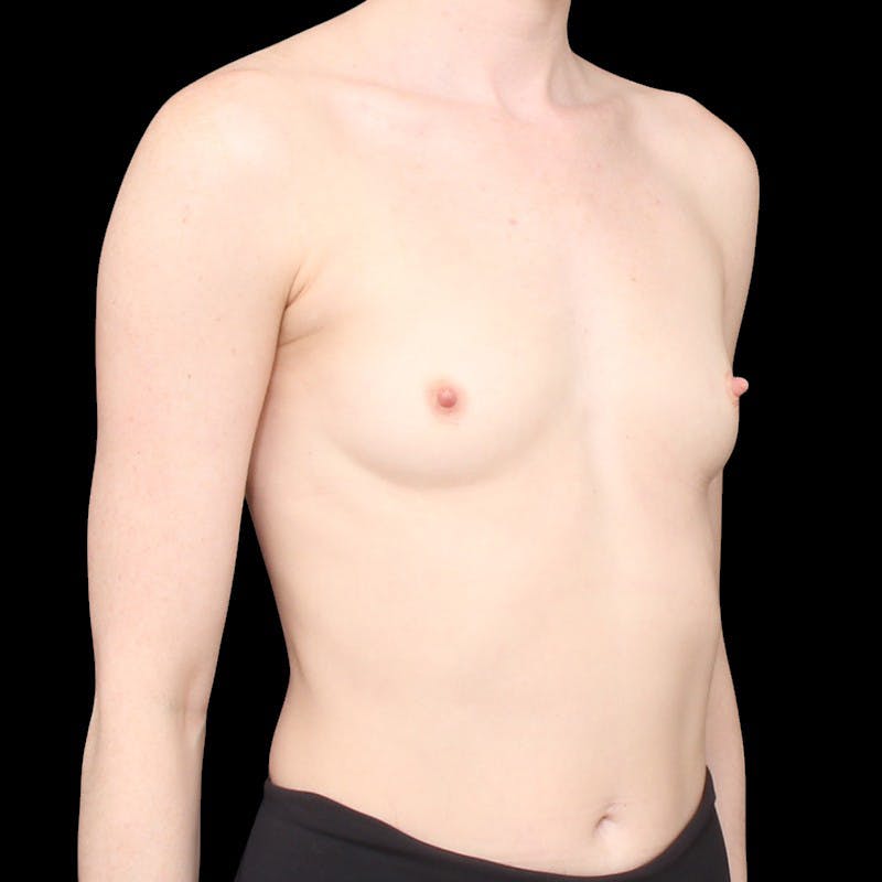 Breast Augmentation Before & After Gallery - Patient 343754 - Image 3