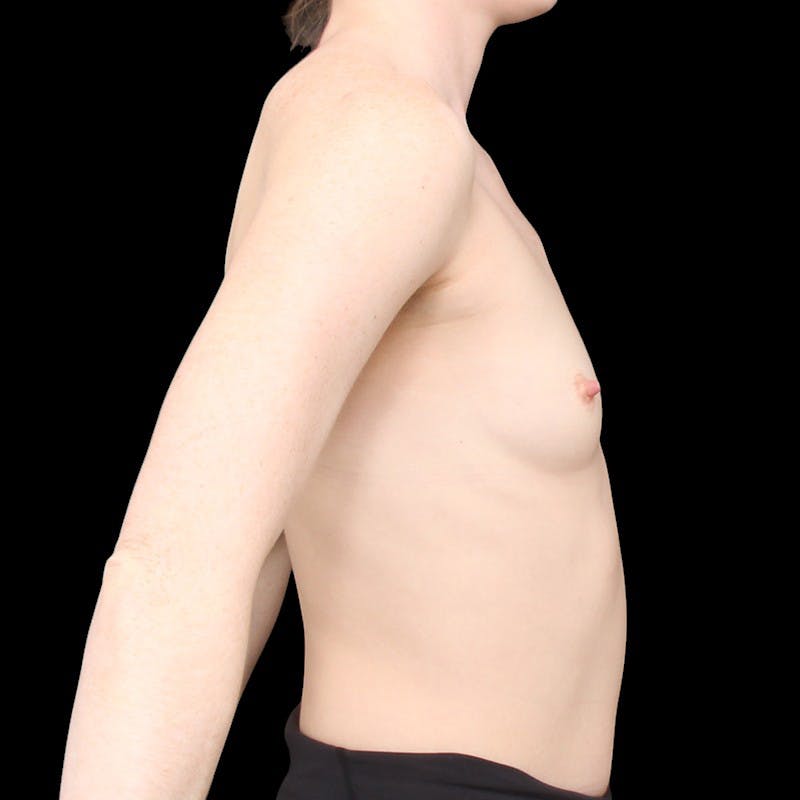 Breast Augmentation Before & After Gallery - Patient 343754 - Image 5