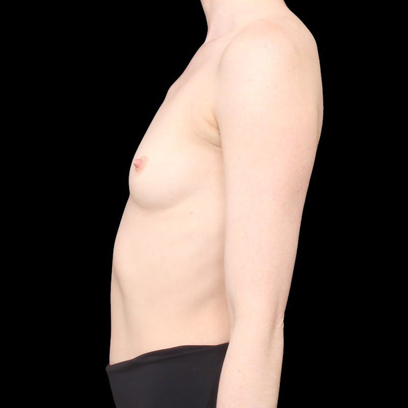 Breast Augmentation Before & After Gallery - Patient 343754 - Image 9