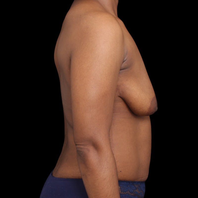 Breast Augmentation with Lift Before & After Gallery - Patient 413355 - Image 5