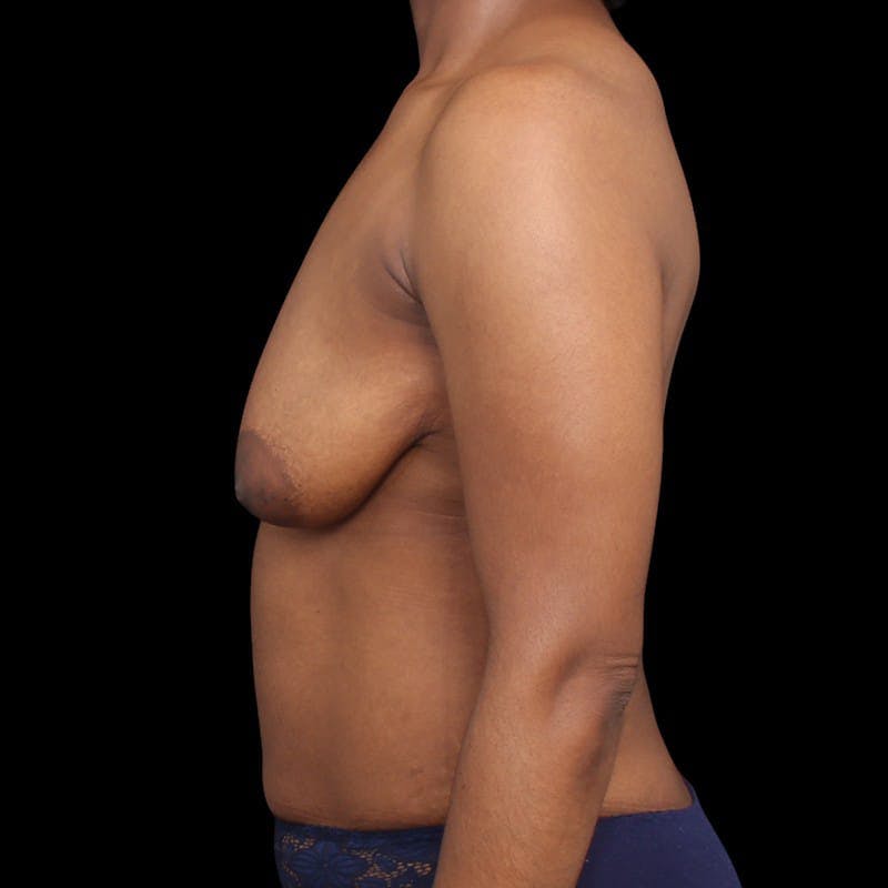 Breast Augmentation with Lift Before & After Gallery - Patient 413355 - Image 9
