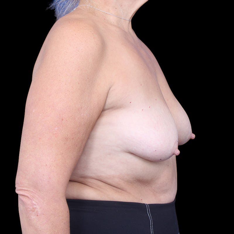 Breast Augmentation with Lift Before & After Gallery - Patient 987972 - Image 5