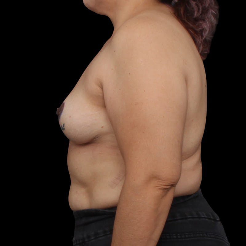 Breast Implant Removal Before & After Gallery - Patient 170315 - Image 8