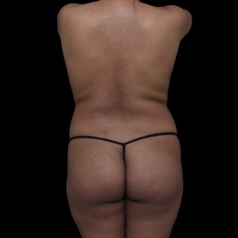 Liposuction Before & After Gallery - Patient 103262 - Image 15