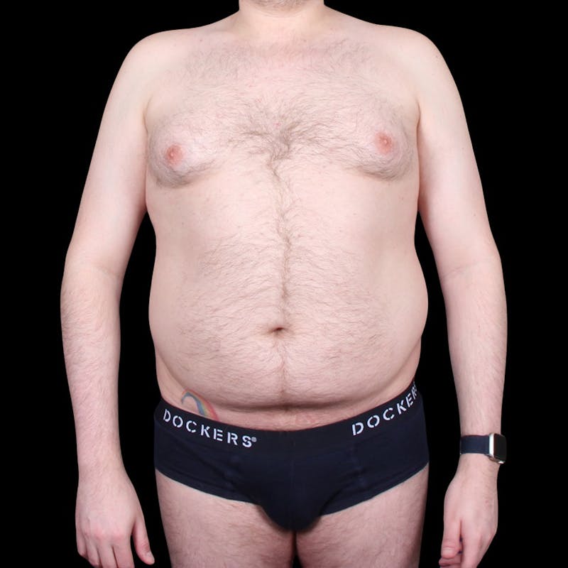 Liposuction Before & After Gallery - Patient 327784 - Image 3