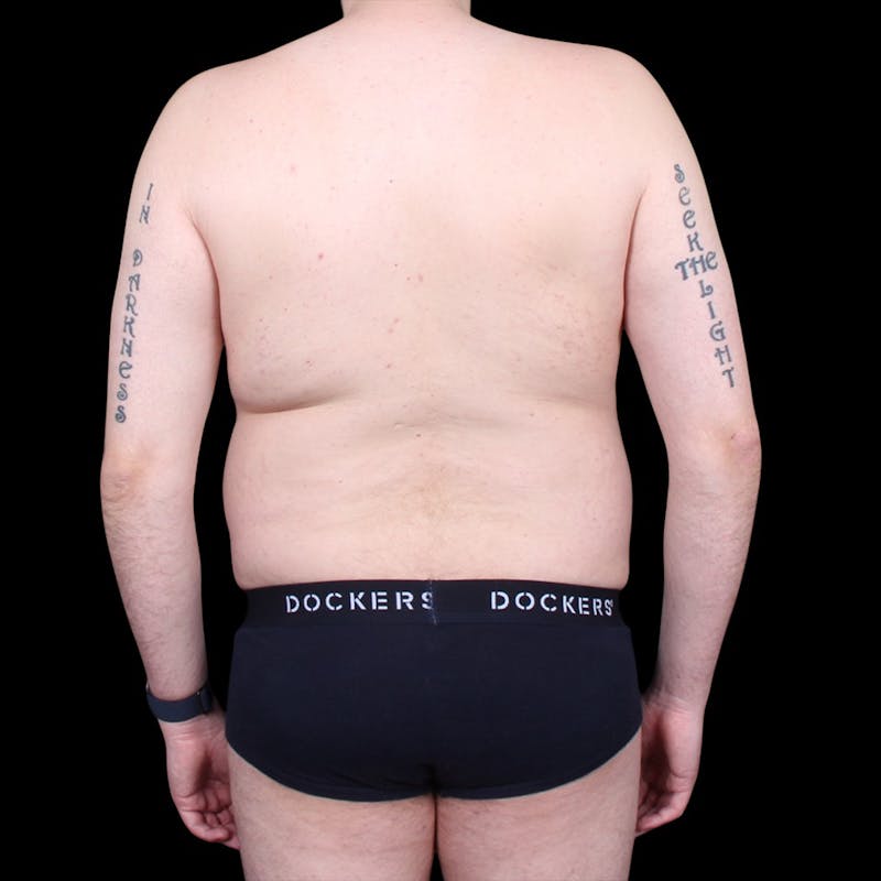 Liposuction Before & After Gallery - Patient 327784 - Image 11