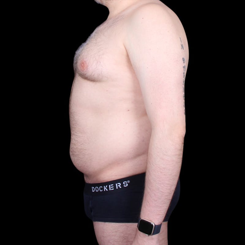 Liposuction Before & After Gallery - Patient 327784 - Image 5