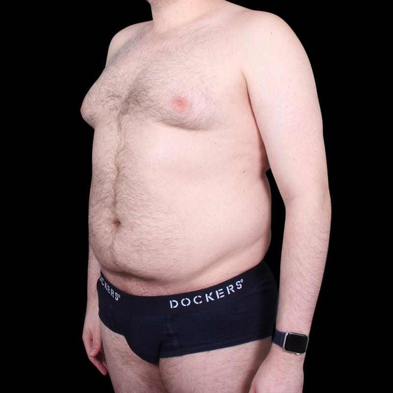 Liposuction Before & After Gallery - Patient 327784 - Image 1