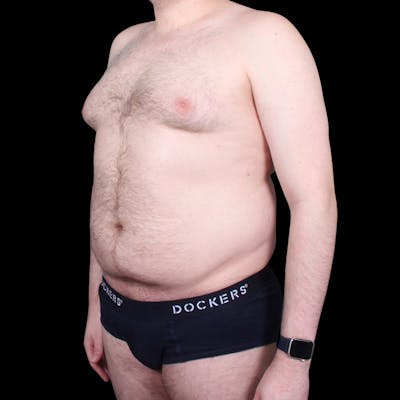 Liposuction Before & After Gallery - Patient 327784 - Image 1