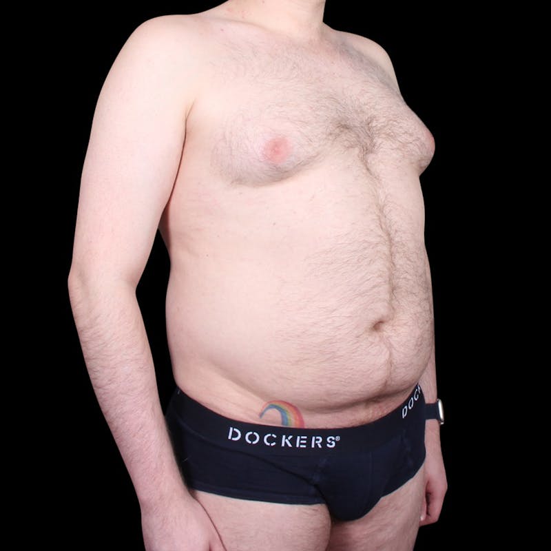 Liposuction Before & After Gallery - Patient 327784 - Image 7