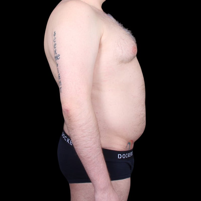 Liposuction Before & After Gallery - Patient 327784 - Image 9