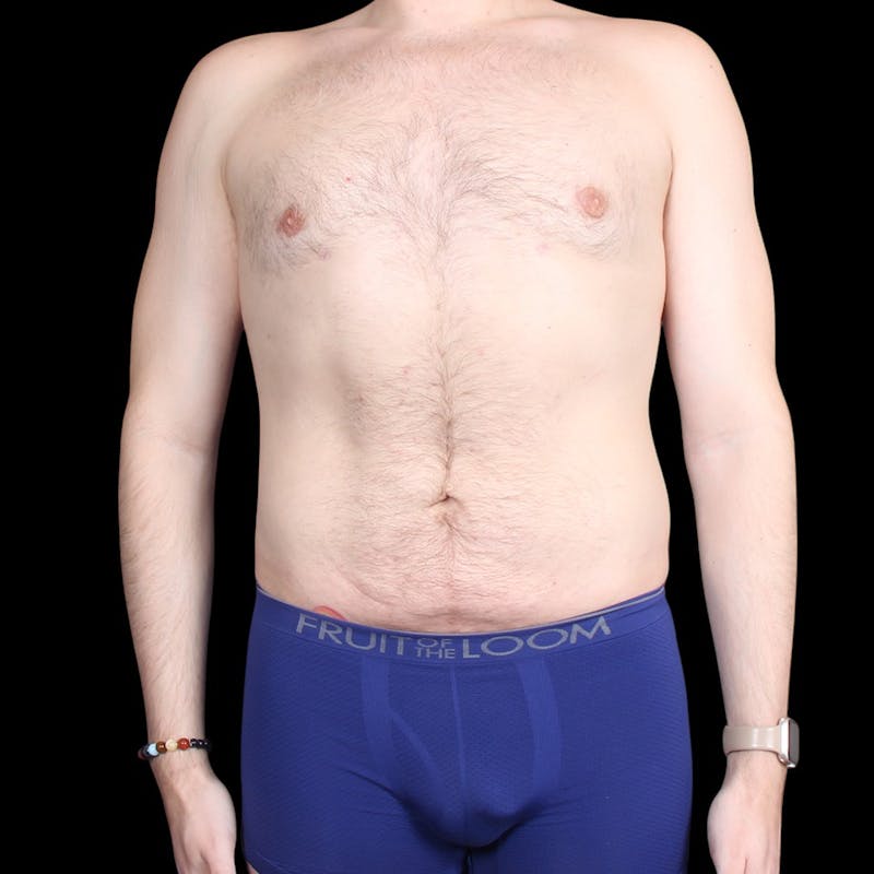 Liposuction Before & After Gallery - Patient 327784 - Image 4