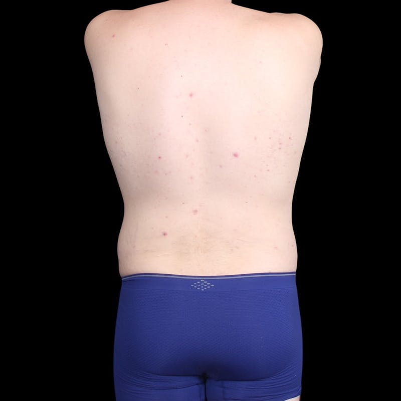 Liposuction Before & After Gallery - Patient 327784 - Image 12