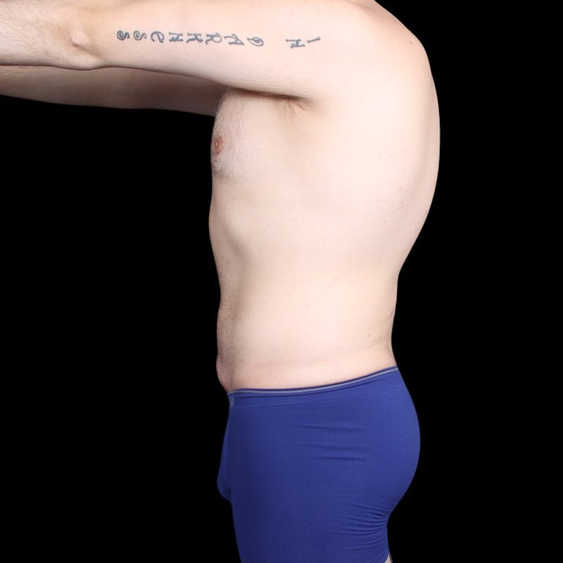 Liposuction Before & After Gallery - Patient 327784 - Image 6